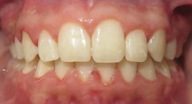 After treatment - Patient 14 orthodontic treatment at Lefort Orthodontics