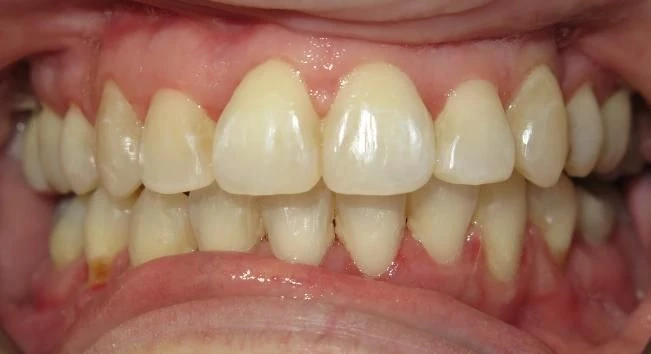 After treatment - Patient 5 orthodontic treatment at Lefort Orthodontics
