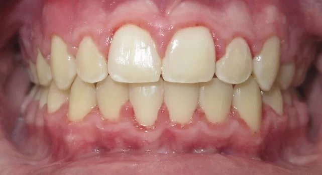 After treatment - Patient 9 orthodontic treatment at Lefort Orthodontics