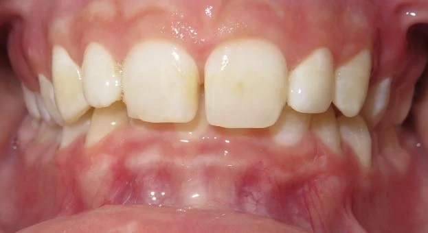 Before treatment - Patient 10 orthodontic treatment at Lefort Orthodontics
