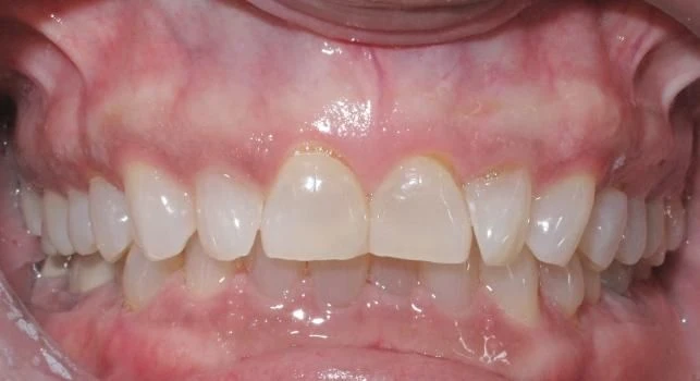 Before treatment - Patient 13 orthodontic treatment at Lefort Orthodontics
