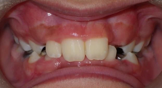 Before treatment - Patient 14 orthodontic treatment at Lefort Orthodontics